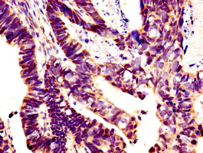 GLI / GLI1 Antibody - IHC image of GLI1 Antibody diluted at 1:400 and staining in paraffin-embedded human ovarian cancer performed on a Leica BondTM system. After dewaxing and hydration, antigen retrieval was mediated by high pressure in a citrate buffer (pH 6.0). Section was blocked with 10% normal goat serum 30min at RT. Then primary antibody (1% BSA) was incubated at 4°C overnight. The primary is detected by a biotinylated secondary antibody and visualized using an HRP conjugated SP system.