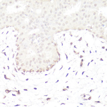 GLI / GLI1 Antibody - Immunohistochemistry of paraffin-embedded human mammary cancer using GLI1 antibody at dilution of 1:100 (40x lens).