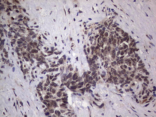 GLI2 Antibody - IHC of paraffin-embedded Human testicular cancer tissue using anti-GLI2 mouse monoclonal antibody. (Heat-induced epitope retrieval by 1 mM EDTA in 10mM Tris, pH8.5, 120°C for 3min).