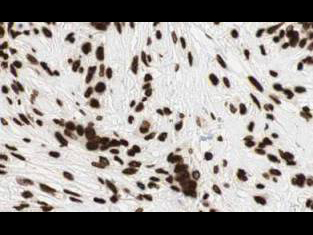 GLI2 Antibody - Affinity Purified anti-Gli2 antibody shows strong cytoplasmic and membranous staining of tumor cells in human breast tissue. Tissue was formalin-fixed and paraffin embedded. Brown color indicates presence of protein, blue color shows cell nuclei.