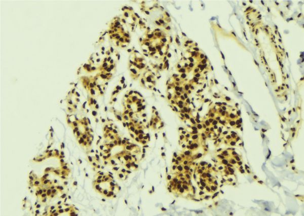 GLI2 Antibody - 1:100 staining human breast carcinoma tissue by IHC-P. The sample was formaldehyde fixed and a heat mediated antigen retrieval step in citrate buffer was performed. The sample was then blocked and incubated with the antibody for 1.5 hours at 22°C. An HRP conjugated goat anti-rabbit antibody was used as the secondary.