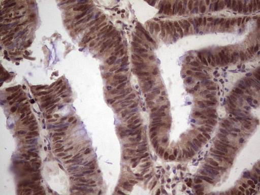 GLI4 Antibody - Immunohistochemical staining of paraffin-embedded Adenocarcinoma of Human colon tissue using anti-GLI4 mouse monoclonal antibody. (Heat-induced epitope retrieval by 1 mM EDTA in 10mM Tris, pH8.5, 120C for 3min,
