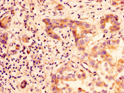 GLIPR1 / GLIPR Antibody - IHC image of GLIPR1 Antibody diluted at 1:100 and staining in paraffin-embedded human liver cancer performed on a Leica BondTM system. After dewaxing and hydration, antigen retrieval was mediated by high pressure in a citrate buffer (pH 6.0). Section was blocked with 10% normal goat serum 30min at RT. Then primary antibody (1% BSA) was incubated at 4°C overnight. The primary is detected by a biotinylated secondary antibody and visualized using an HRP conjugated SP system.
