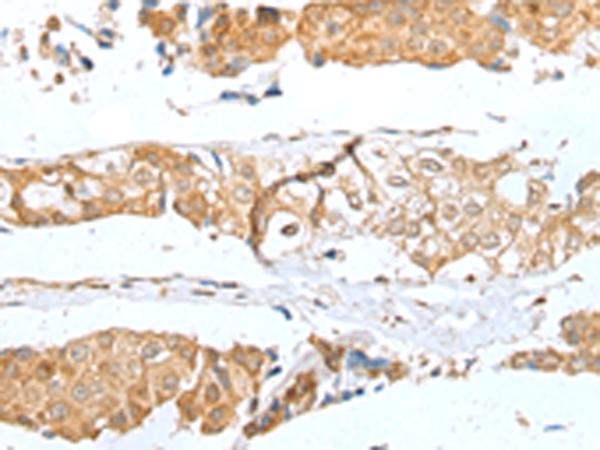 GLIPR1L1 Antibody - Immunohistochemistry of paraffin-embedded Human breast cancer tissue  using GLIPR1L1 Polyclonal Antibody at dilution of 1:25(×200)