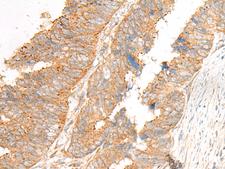 GLIS1 Antibody - Immunohistochemistry of paraffin-embedded Human colorectal cancer tissue  using GLIS1 Polyclonal Antibody at dilution of 1:50(×200)