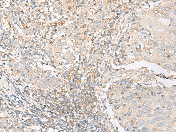 GLIS1 Antibody - Immunohistochemistry of paraffin-embedded Human cervical cancer tissue  using GLIS1 Polyclonal Antibody at dilution of 1:50(×200)