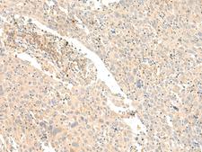 GLIS1 Antibody - Immunohistochemistry of paraffin-embedded Human cervical cancer tissue  using GLIS1 Polyclonal Antibody at dilution of 1:40(×200)