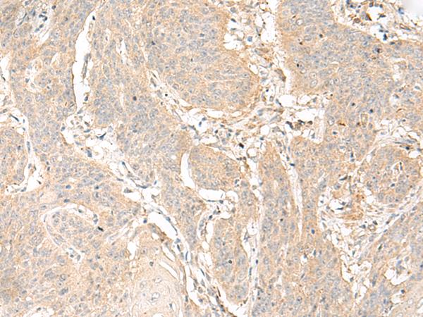 GLIS1 Antibody - Immunohistochemistry of paraffin-embedded Human esophagus cancer tissue  using GLIS1 Polyclonal Antibody at dilution of 1:40(×200)