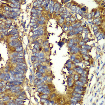 GLNRS / QARS Antibody - Immunohistochemistry of paraffin-embedded human colon carcinoma tissue.