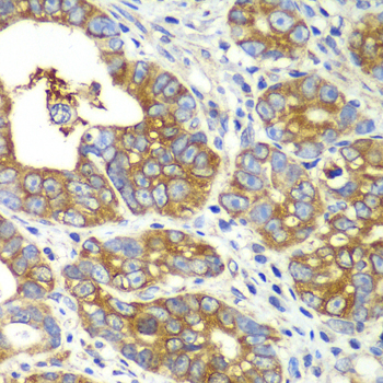 GLNRS / QARS Antibody - Immunohistochemistry of paraffin-embedded human gastric cancer tissue.