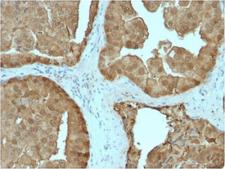 GLO1 / Glyoxalase I Antibody - IHC testing of FFPE human prostate carcinoma stained with GLO1 antibody. Required HIER: boiling tissue sections in 10mM citrate buffer, pH6, for 10-20 min followed by cooling at RT for 20 min.