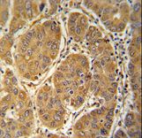 GLOD2 / MCEE Antibody - MCEE antibody immunohistochemistry of formalin-fixed and paraffin-embedded human hepatocarcinoma followed by peroxidase-conjugated secondary antibody and DAB staining.