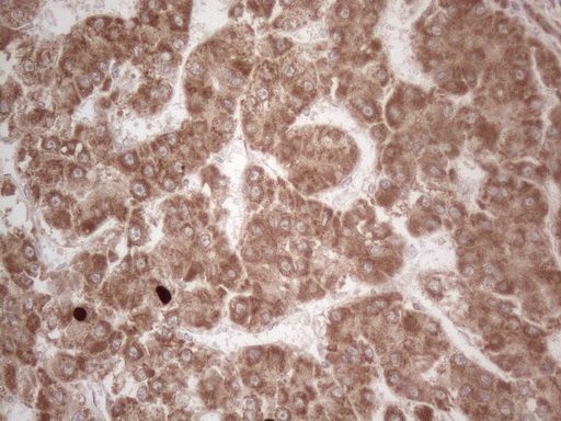 GLOD2 / MCEE Antibody - Immunohistochemical staining of paraffin-embedded Carcinoma of Human liver tissue using anti-MCEE mouse monoclonal antibody. (Heat-induced epitope retrieval by 1mM EDTA in 10mM Tris buffer. (pH8.5) at 120°C for 3 min. (1:150)