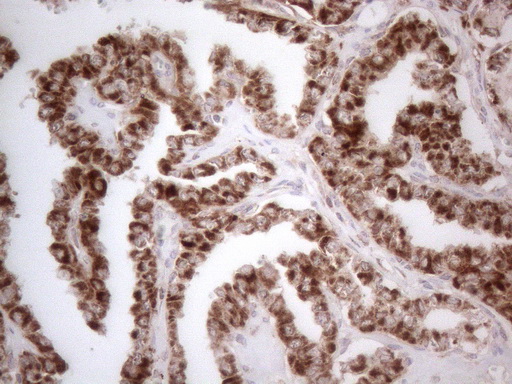 GLOD2 / MCEE Antibody - Immunohistochemical staining of paraffin-embedded Carcinoma of Human thyroid tissue using anti-MCEE mouse monoclonal antibody. (Heat-induced epitope retrieval by 1mM EDTA in 10mM Tris buffer. (pH8.5) at 120°C for 3 min. (1:150)