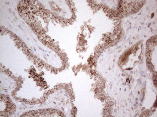 GLOD2 / MCEE Antibody - Immunohistochemical staining of paraffin-embedded Carcinoma of Human prostate tissue using anti-MCEE mouse monoclonal antibody. (Heat-induced epitope retrieval by 1mM EDTA in 10mM Tris buffer. (pH8.5) at 120°C for 3 min. (1:150)