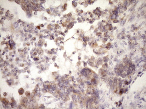GLOD2 / MCEE Antibody - Immunohistochemical staining of paraffin-embedded Adenocarcinoma of Human endometrium tissue using anti-MCEE mouse monoclonal antibody. (Heat-induced epitope retrieval by Tris-EDTA, pH8.0)(1:150)