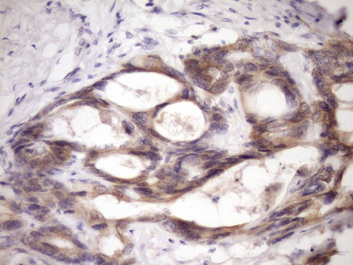 GLOD2 / MCEE Antibody - Immunohistochemical staining of paraffin-embedded Adenocarcinoma of Human colon tissue using anti-MCEE mouse monoclonal antibody. (Heat-induced epitope retrieval by Tris-EDTA, pH8.0)(1:150)