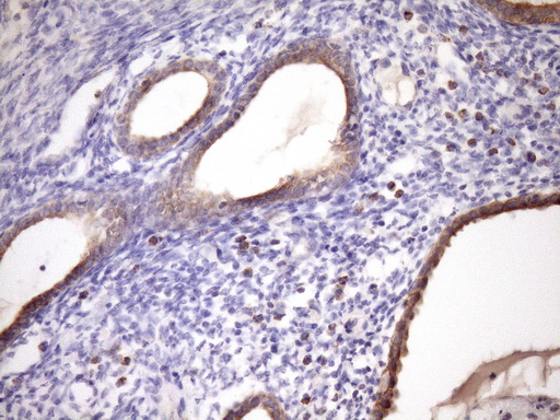 GLOD2 / MCEE Antibody - IHC of paraffin-embedded Carcinoma of Human pancreas tissue using anti-MCEE mouse monoclonal antibody. (Heat-induced epitope retrieval by Tris-EDTA, pH8.0)(1:150).