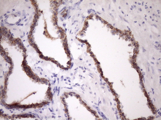 GLOD2 / MCEE Antibody - IHC of paraffin-embedded Carcinoma of Human prostate tissue using anti-MCEE mouse monoclonal antibody. (Heat-induced epitope retrieval by Tris-EDTA, pH8.0)(1:150).