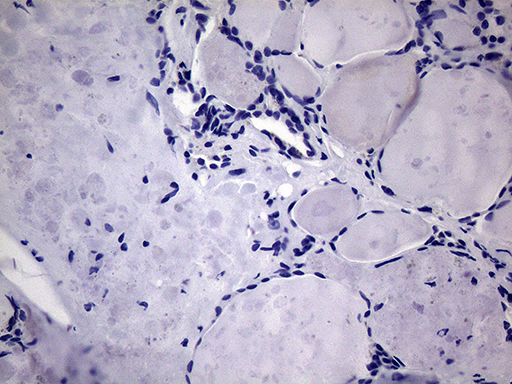 GLOD2 / MCEE Antibody - Immunohistochemical staining of paraffin-embedded Human thyroid tissue within the normal limits using anti-MCEE mouse monoclonal antibody.This figure shows negative staining. (Heat-induced epitope retrieval by 1mM EDTA in 10mM Tris buffer. (pH8.5) at 120°C for 3 min. (1:2000)