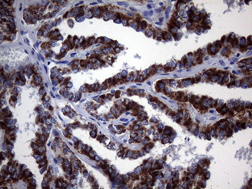 GLOD2 / MCEE Antibody - Immunohistochemical staining of paraffin-embedded Carcinoma of Human thyroid tissue using anti-MCEE mouse monoclonal antibody. (Heat-induced epitope retrieval by 1mM EDTA in 10mM Tris buffer. (pH8.5) at 120°C for 3 min. (1:2000)