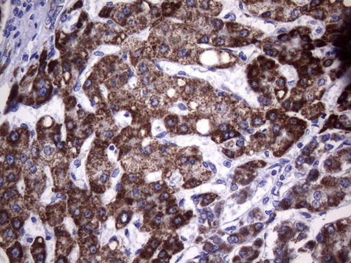 GLOD2 / MCEE Antibody - Immunohistochemical staining of paraffin-embedded Carcinoma of Human liver tissue using anti-MCEE mouse monoclonal antibody. (Heat-induced epitope retrieval by 1mM EDTA in 10mM Tris buffer. (pH8.5) at 120°C for 3 min. (1:2000)