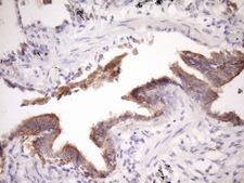 GLOD2 / MCEE Antibody - Immunohistochemical staining of paraffin-embedded Carcinoma of Human lung tissue using anti-MCEE mouse monoclonal antibody. (Heat-induced epitope retrieval by Tris-EDTA, pH8.0)(1:150)