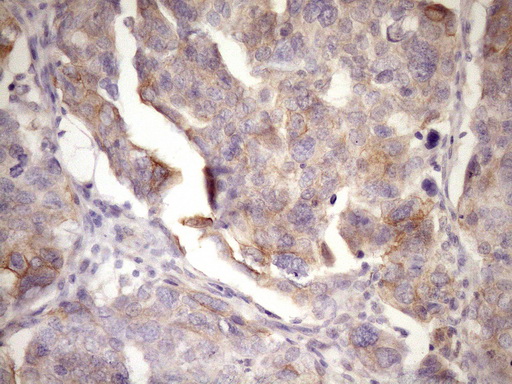 GLOD2 / MCEE Antibody - Immunohistochemical staining of paraffin-embedded Adenocarcinoma of Human ovary tissue using anti-MCEE mouse monoclonal antibody. (Heat-induced epitope retrieval by Tris-EDTA, pH8.0)(1:150)