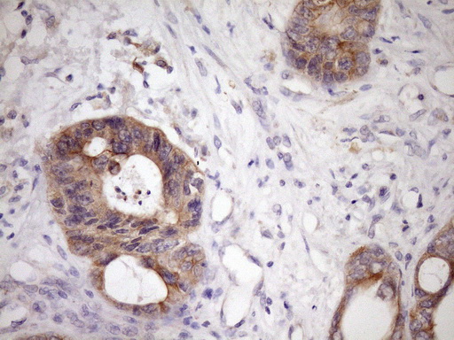 GLOD2 / MCEE Antibody - Immunohistochemical staining of paraffin-embedded Adenocarcinoma of Human colon tissue using anti-MCEE mouse monoclonal antibody. (Heat-induced epitope retrieval by Tris-EDTA, pH8.0)(1:150)