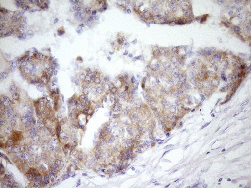 GLOD2 / MCEE Antibody - Immunohistochemical staining of paraffin-embedded Carcinoma of Human liver tissue using anti-MCEE mouse monoclonal antibody. (Heat-induced epitope retrieval by Tris-EDTA, pH8.0)(1:150)