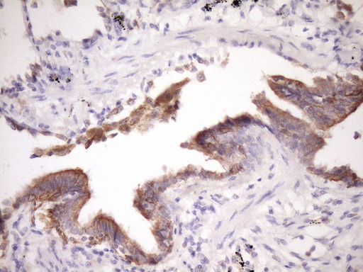 GLOD2 / MCEE Antibody - IHC of paraffin-embedded Carcinoma of Human lung tissue using anti-MCEE mouse monoclonal antibody. (Heat-induced epitope retrieval by Tris-EDTA, pH8.0)(1:150).