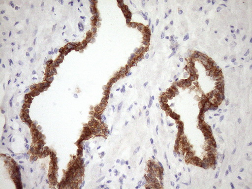 GLOD2 / MCEE Antibody - IHC of paraffin-embedded Carcinoma of Human prostate tissue using anti-MCEE mouse monoclonal antibody. (Heat-induced epitope retrieval by Tris-EDTA, pH8.0)(1:150).