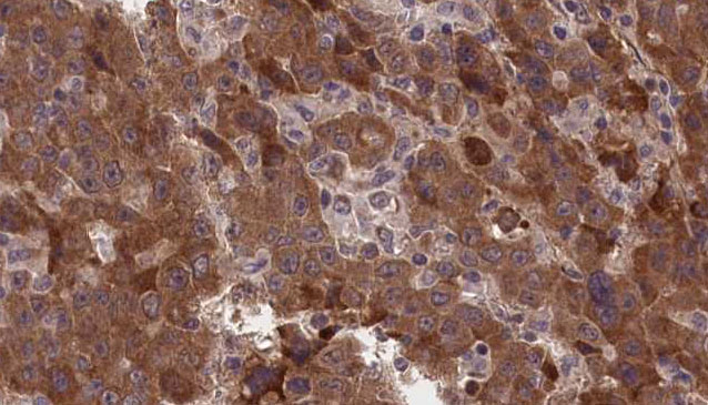 GLRA1/Glycine Receptor Alpha 1 Antibody - 1:100 staining human liver carcinoma tissues by IHC-P. The sample was formaldehyde fixed and a heat mediated antigen retrieval step in citrate buffer was performed. The sample was then blocked and incubated with the antibody for 1.5 hours at 22°C. An HRP conjugated goat anti-rabbit antibody was used as the secondary.