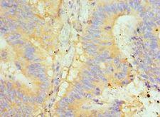 GLRX2 / Glutaredoxin 2 Antibody - Immunohistochemistry of paraffin-embedded human colon cancer using antibody at 1:100 dilution.