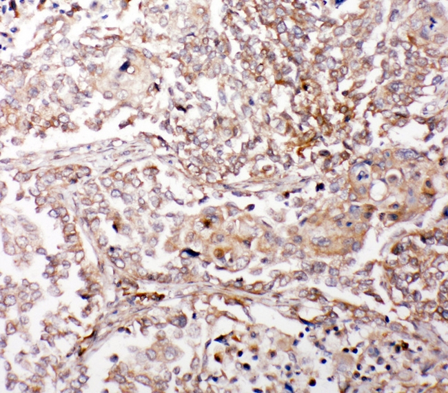 GLRX2 / Glutaredoxin 2 Antibody - IHC analysis of Glutaredoxin 2 using anti-Glutaredoxin 2 antibody. Glutaredoxin 2 was detected in paraffin-embedded section of human lung cancer tissue. Heat mediated antigen retrieval was performed in citrate buffer (pH6, epitope retrieval solution) for 20 mins. The tissue section was blocked with 10% goat serum. The tissue section was then incubated with 1µg/ml rabbit anti-Glutaredoxin 2 Antibody overnight at 4°C. Biotinylated goat anti-rabbit IgG was used as secondary antibody and incubated for 30 minutes at 37°C. The tissue section was developed using Strepavidin-Biotin-Complex (SABC) with DAB as the chromogen.