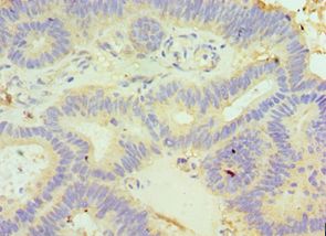 GLRX3 / Glutaredoxin 3 Antibody - Immunohistochemistry of paraffin-embedded human colon cancer using antibody at 1:100 dilution.