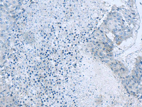 GLS / Glutaminase Antibody - Immunohistochemistry of paraffin-embedded Human liver cancer tissue  using GLS Polyclonal Antibody at dilution of 1:60(×200)