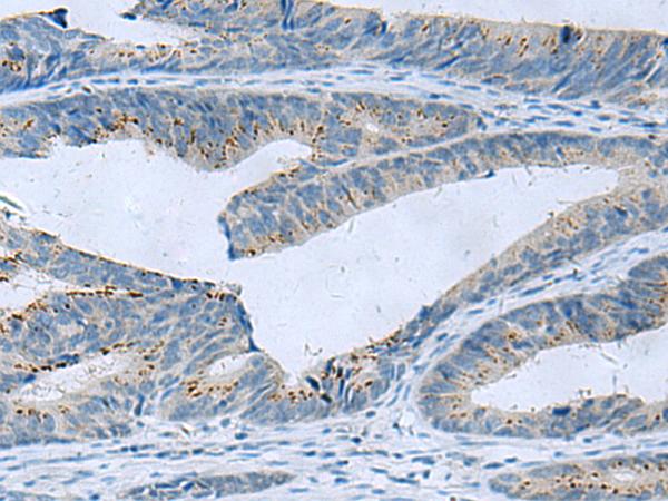 GLS / Glutaminase Antibody - Immunohistochemistry of paraffin-embedded Human colorectal cancer tissue  using GLS Polyclonal Antibody at dilution of 1:60(×200)