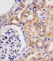 GLS2 / Glutaminase 2 Antibody - GLS2 Antibody staining GLS2 in human kidney tissue sections by Immunohistochemistry (IHC-P - paraformaldehyde-fixed, paraffin-embedded sections). Tissue was fixed with formaldehyde and blocked with 3% BSA for 0. 5 hour at room temperature; antigen retrieval was by heat mediation with a citrate buffer (pH6). Samples were incubated with primary antibody (1/25) for 1 hours at 37°C. A undiluted biotinylated goat polyvalent antibody was used as the secondary antibody.