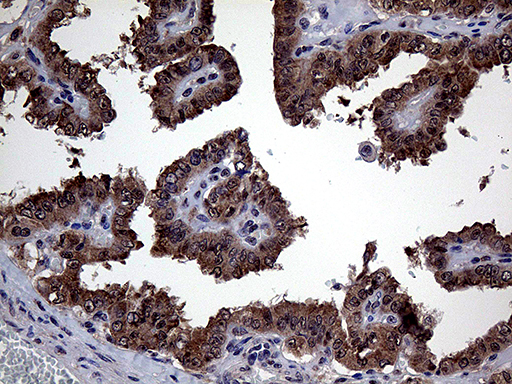 GLS2 / Glutaminase 2 Antibody - Immunohistochemical staining of paraffin-embedded Carcinoma of Human thyroid tissue using anti-GLS2 mouse monoclonal antibody. (Heat-induced epitope retrieval by 1mM EDTA in 10mM Tris buffer. (pH8.5) at 120°C for 3 min. (1:2000)