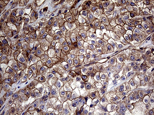 GLS2 / Glutaminase 2 Antibody - Immunohistochemical staining of paraffin-embedded Carcinoma of Human kidney tissue using anti-GLS2 mouse monoclonal antibody. (Heat-induced epitope retrieval by 1mM EDTA in 10mM Tris buffer. (pH8.5) at 120°C for 3 min. (1:2000)