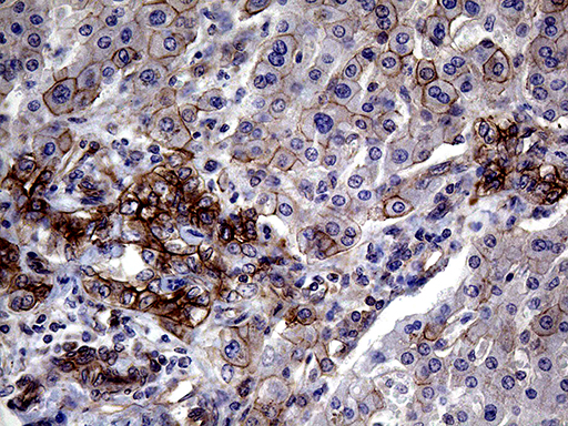 GLS2 / Glutaminase 2 Antibody - Immunohistochemical staining of paraffin-embedded Carcinoma of Human liver tissue using anti-GLS2 mouse monoclonal antibody. (Heat-induced epitope retrieval by 1mM EDTA in 10mM Tris buffer. (pH8.5) at 120°C for 3 min. (1:2000)