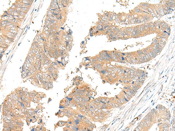 GLS2 / Glutaminase 2 Antibody - Immunohistochemistry of paraffin-embedded Human colorectal cancer tissue  using GLS2 Polyclonal Antibody at dilution of 1:45(×200)