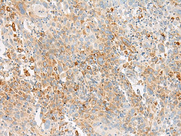 GLS2 / Glutaminase 2 Antibody - Immunohistochemistry of paraffin-embedded Human cervical cancer tissue  using GLS2 Polyclonal Antibody at dilution of 1:60(×200)