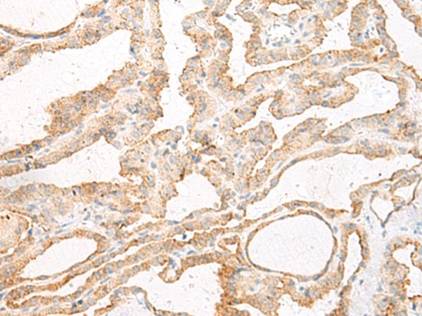 GLS2 / Glutaminase 2 Antibody - Immunohistochemistry of paraffin-embedded Human thyroid cancer tissue  using GLS2 Polyclonal Antibody at dilution of 1:60(×200)