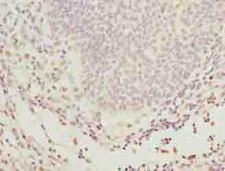GLT1D1 Antibody - Immunohistochemistry of paraffin-embedded human bladder carcinoma using antibody at dilution of 1:100.