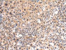 GLT8D1 Antibody - Immunohistochemistry of paraffin-embedded Human liver cancer tissue  using GLT8D1 Polyclonal Antibody at dilution of 1:90(×200)