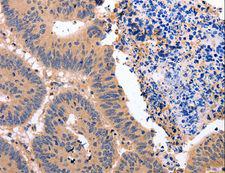 Glucocorticoid Receptor Beta Antibody - Immunohistochemistry of paraffin-embedded Human colon cancer using NR3C1 Polyclonal Antibody at dilution of 1:50.