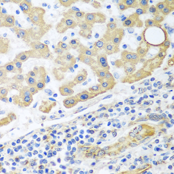 GLUD1/Glutamate Dehydrogenase Antibody - Immunohistochemistry of paraffin-embedded human liver cancer tissue.