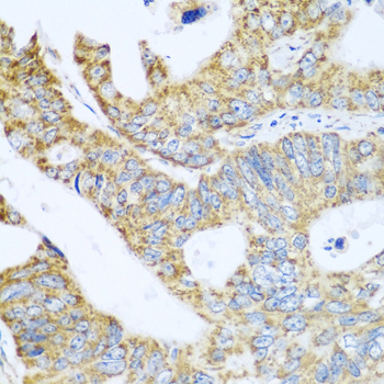 GLUD1/Glutamate Dehydrogenase Antibody - Immunohistochemistry of paraffin-embedded human colon carcinoma tissue.